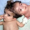 В Египте врачи удалили голову двухголовой новорожденной девочке