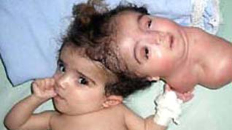 В Египте врачи удалили голову двухголовой новорожденной девочке