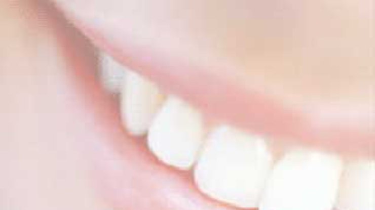 Белоснежка и семь стоматологов, или Вся правда об отбеливании зубов