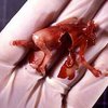 Американский акушер употреблял в пищу человеческие эмбрионы
