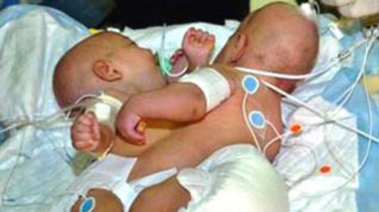 В Саудовской Аравии врачи смогли разделить сиамских близнецов Алю и Валю