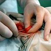 В Малайзии проведена операция по вживлению искусственного сердца