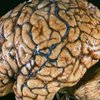 Ученые определили причину развития эпилепсии у подростков
