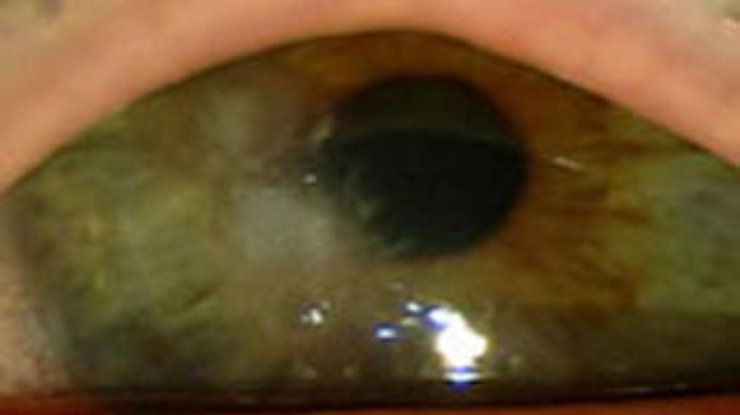 Использование контактных линз может привести к грибковой инфекции глаз
