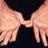 Людям, больным ревматоидным артритом угрожает лимфома