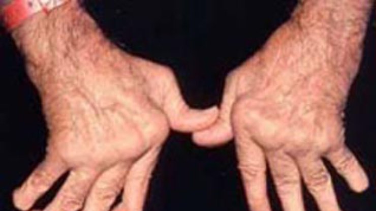 Людям, больным ревматоидным артритом угрожает лимфома