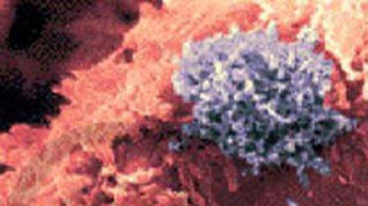 Раскрыт механизм развития Т-клеточного лейкоза