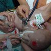 В Шанхае завершилась сложнейшая операция по разделению сиамских близнецов