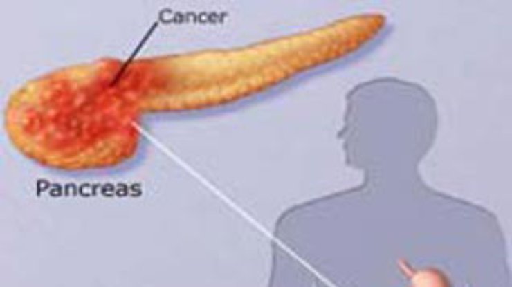 Установлена причина агрессивности рака поджелудочной железы