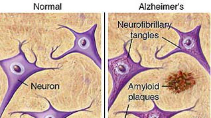 Обнаружен новый метод лечения болезни Альцгеймера