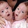 В США готовят к разделению двухмесячных сиамских близнецов