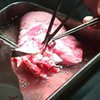 ВИЧ пациенту в Италии  трансплантировали легкое