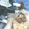 Древнейший образец вируса гепатита нашли в корейской мумии