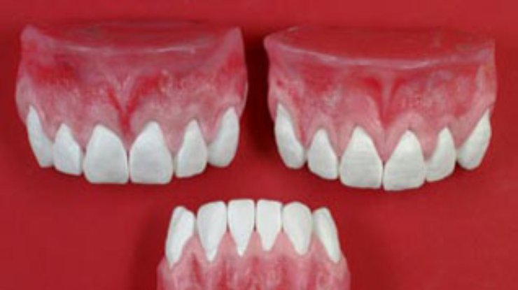 Отсутствие зубов влияет на развитие слабоумия