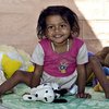В Индии девочку отделили от близнеца-паразита