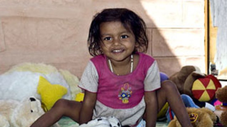 В Индии девочку отделили от близнеца-паразита