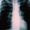 ВОЗ: Украина стала рассадником "атипичного" туберкулеза