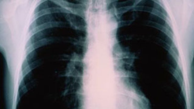 ВОЗ: Украина стала рассадником "атипичного" туберкулеза