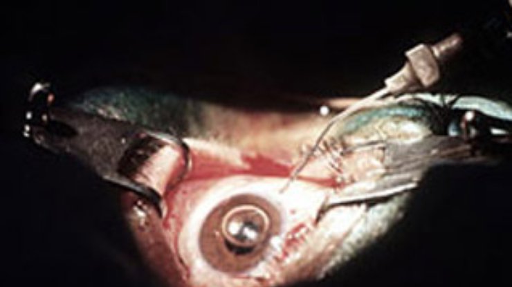 Зуб за око: Ирландцу пересадили зуб в глазницу и вернули зрение