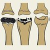 Американские ученые создали искусственные кости