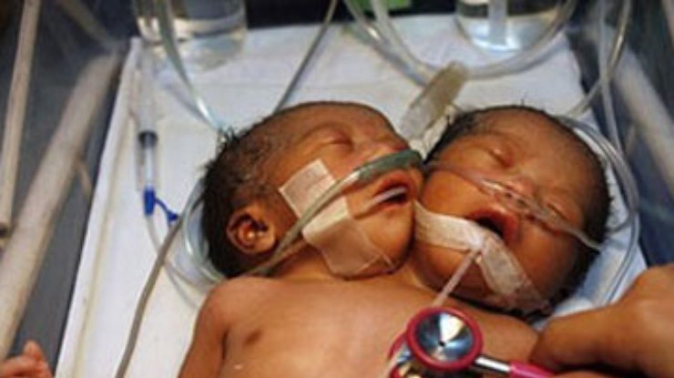 На Филиппинах родился двухголовый ребенок
