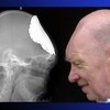 У 72-летнего британца вырос новый череп