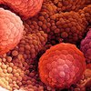 Выявлены антитела, уничтожающие рак простаты