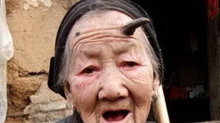 У пожилой китаянки вырос рог