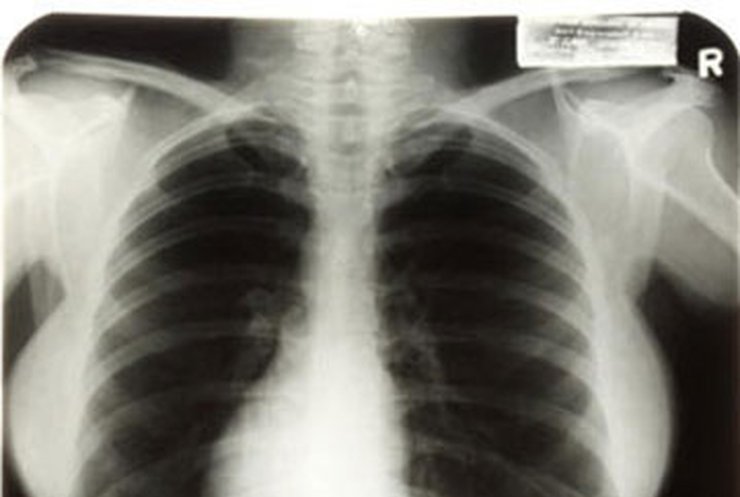Рентгеновские снимки Мэрилин Монро оценили в 45 тысяч долларов