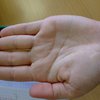В Италии у женщины "склеились" пальцы левой руки