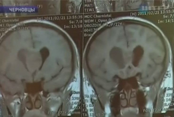В Черновцах девушке с опухолью головного мозга не хватает денег на операцию