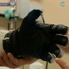 В Австрии двум парням установили бионические протезы рук
