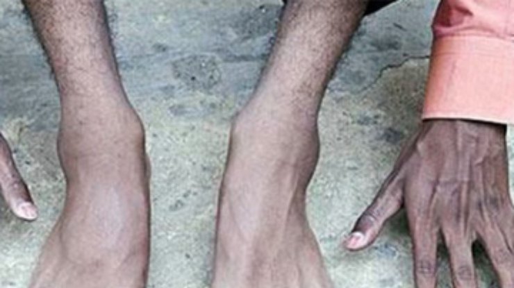 Индийский мальчик  родился с рекордным количеством пальцев