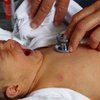 В крупнейшей больнице Рима 79 новорожденных заразили туберкулезом