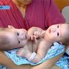 Китайским врачам удалось разъединить сиамских близнецов