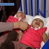 Впервые в истории врачи разделили сросшихся головами сиамских близнецов