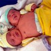 Бразильянка родила двухголового ребенка