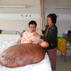 Врачи удалили вьетнамцу 90-килограмовую опухоль