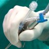 Испанские врачи провели уникальную внутриутробную операцию