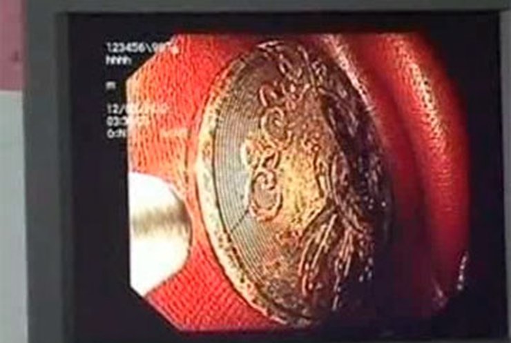 В Китае спасли мальчика, который проглотил монету