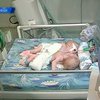 Донецкие врачи борются за жизнь сиамских близнецов