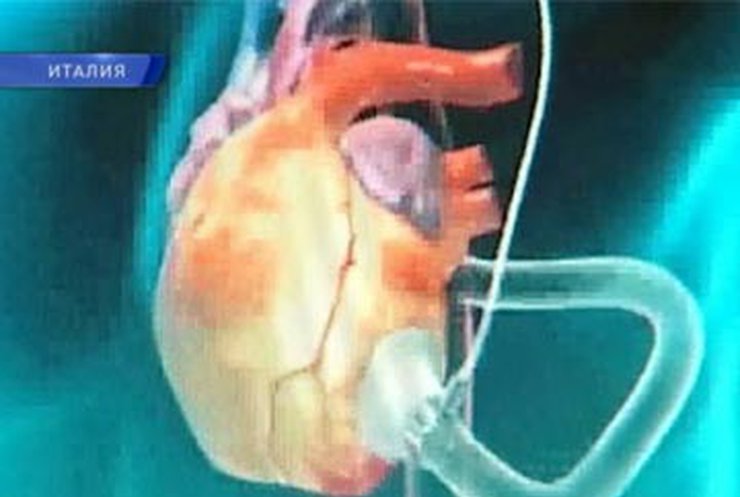 Итальянские хирурги пересадили искусственное сердце младенцу