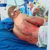 Состояние пострадавших на газокомпрессорной станции остается тяжелым