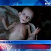 Донецкая милиция расследует загадочное истощение 5-месячного ребенка