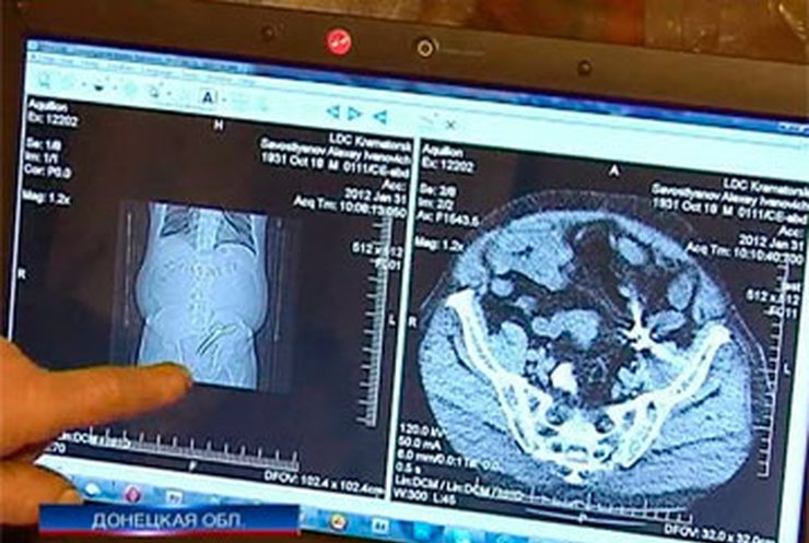 Донецкий хирург забыл в теле пациента зажим
