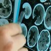У парня, которому проломили череп грабители, начал восстанавливаться мозг