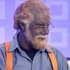 В США умер "человек с синей кожей", страдающий от редкого заболевания