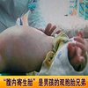 В Китае двухлетний ребенок шокировал врачей, родив своего близнеца