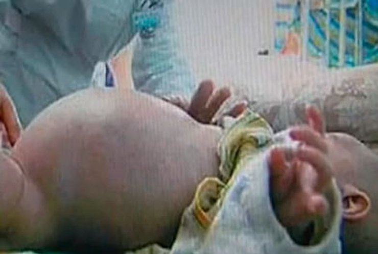 В Китае двухлетний ребенок шокировал врачей, родив своего близнеца
