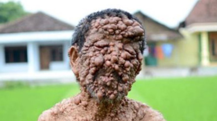 Тело пожилого индонезийца покрыли ужасные опухоли